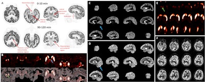 F-18 SynVesT-1 images at early (0-10) and late (90-120 minute) times postinjection. There is clear identification of high flow regions in the early images. The late images show the synaptic (SV2A) pattern which differs from the flow pattern, e.g., in the thalamus. B. 11C-PHNO binding potential (BPND) images shown in transverse, coronal, and sagittal orientations of PET alone and PET overlaid with MRI. Left: Region of substantia nigra (green arrow, max display: 4.0). Right: Thalamic region (max: 2.5) showing focal bilateral binding in a specific thalamic nucleus (blue arrow, likely anteroventral nucleus). C. Sagittal images of 11C-LSN3172176 M1 muscarinic cholinergic BPND (max display: 10). D. R1 images of the same tracer (max: 2). Cerebellum (blue arrow) shows no specific binding (C) and high tracer delivery (D). E. 18F-FE-PE2I dopamine transporter BPND images (zoomed, max display: 6) showing striatum and substantia nigra (green arrow). F. R1 images of the same tracer (max: 2) with inset showing zoomed region in E.