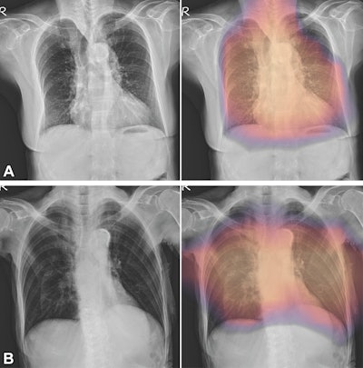 (A, B) Images with true-positive findings. Digital radiographs in (A) a 79-year-old woman with dementia and hypertension and a T-score of −3.4 and (B) an 87-year-old woman with osteoarthritis of the knee and a T-score of −2.7. The AI-enabled chest radiography mainly focused on the vertebrae and ribs around patient’s heart and lung field.
