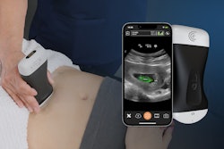 Clarius OB AI automatically highlights key fetal anatomy.