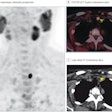 (A) FCH-PET maximum-intensity projection; (B) FCH-PET/CT fusion transverse slice; and (C) low-dose CT transverse slice, showing high FCH uptake in an 11-mm left inferior parathyroid adenoma (arrowheads). The patient underwent minimally invasive parathyroidectomy, leading to normocalcemia during follow-up. No complications occurred.