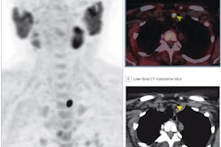 (A) FCH-PET maximum-intensity projection; (B) FCH-PET/CT fusion transverse slice; and (C) low-dose CT transverse slice, showing high FCH uptake in an 11-mm left inferior parathyroid adenoma (arrowheads). The patient underwent minimally invasive parathyroidectomy, leading to normocalcemia during follow-up. No complications occurred.