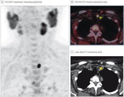 FCH-PET/CT superior to MIBI-SPECT/CT for guiding parathyroid surgery ...