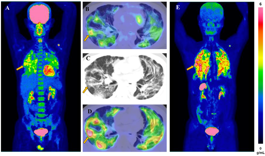 Fdg Fapi Imaging Positive Snmmi 2024