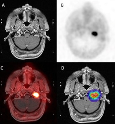 Axial imaging of glomus jugulare and treatment planning. A) T1-weighted MRI with contrast. B) Ga-68 DOTATATE PET/CT. C) MRI-PET fusion. D) Gamma knife radiation dose distribution. Image courtesy of Patrick Wojtylak.