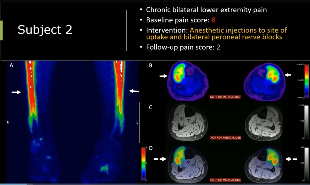 F-18 FTC-146 PET/MRI scan of a 21-year-old male soccer player who participated in the trial. The man had chronic bilateral lower expremity pain with a baseline pain score of 8 out of 10. Based on the finding, the patient underwent anesthetic injections and nerve blocks at the site of radiotracer uptake and reported a pain score of two on a follow-up visit.