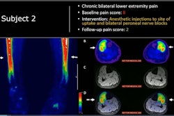 F-18 FTC-146 PET/MRI scan of a 21-year-old male soccer player who participated in the trial. The man had chronic bilateral lower expremity pain with a baseline pain score of 8 out of 10. Based on the finding, the patient underwent anesthetic injections and nerve blocks at the site of radiotracer uptake and reported a pain score of two on a follow-up visit.