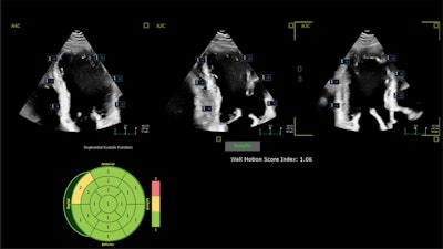New AI software from Philips provides automated wall motion analysis. Image courtesy of Philips.