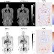 Top row: CT- and LSO-TX-based attenuation maps with their respective percentage relative change (%RC) map. Bottom row: PET images reconstructed using CT- and LSO-TX-based attenuation maps with their respective %RC map. Image and caption courtesy of the SNMMI.