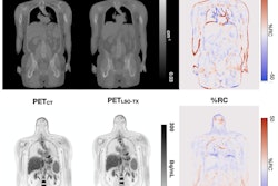 Top row: CT- and LSO-TX-based attenuation maps with their respective percentage relative change (%RC) map. Bottom row: PET images reconstructed using CT- and LSO-TX-based attenuation maps with their respective %RC map. Image and caption courtesy of the SNMMI.