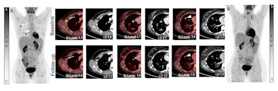 Between baseline A on the left and interim B on the right, the upper row shows baseline F-18-FDG PET. Note the right axillary lymph node (white arrow) and two nodules in the right upper lobe (black arrow and white arrow head). Lower row shows disease response of the lesions by PERCIST on the interim F-18-FDG PET and by RECIST on the CT are shown. Image courtesy of SNMMI.