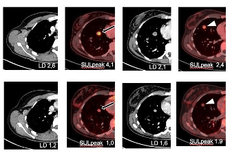 Snmmi Y90 Fapi46 Cohort Lanzafame Thumb