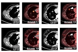 Snmmi Y90 Fapi46 Cohort Lanzafame Thumb