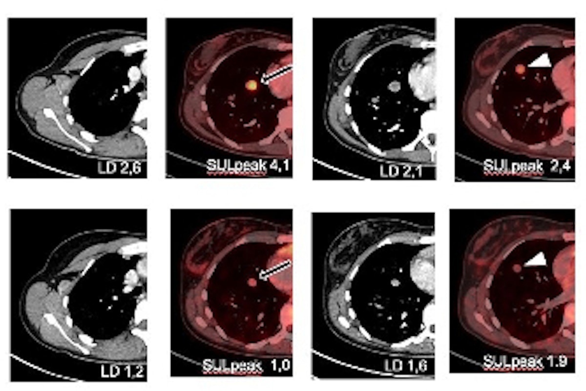 SNMMI: Y-90-FAPI-46 more effective for advanced sarcoma | AuntMinnie