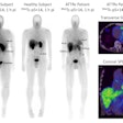 Representative whole-body planar images of Tc-99m p5+14 of healthy subjects and, with SPECT/CT images, of a patient with ATTRv cardiac amyloidosis at 1 hour post injection showing no uptake in the heart of the healthy subject and intense signal in the heart of the patient using both planar and SPECT/CT imaging. Image and caption courtesy of the SNMMI.