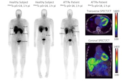 Representative whole-body planar images of Tc-99m p5+14 of healthy subjects and, with SPECT/CT images, of a patient with ATTRv cardiac amyloidosis at 1 hour post injection showing no uptake in the heart of the healthy subject and intense signal in the heart of the patient using both planar and SPECT/CT imaging. Image and caption courtesy of the SNMMI.