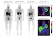 Representative whole-body planar images of Tc-99m p5+14 of healthy subjects and, with SPECT/CT images, of a patient with ATTRv cardiac amyloidosis at 1 hour post injection showing no uptake in the heart of the healthy subject and intense signal in the heart of the patient using both planar and SPECT/CT imaging. Image and caption courtesy of the SNMMI.