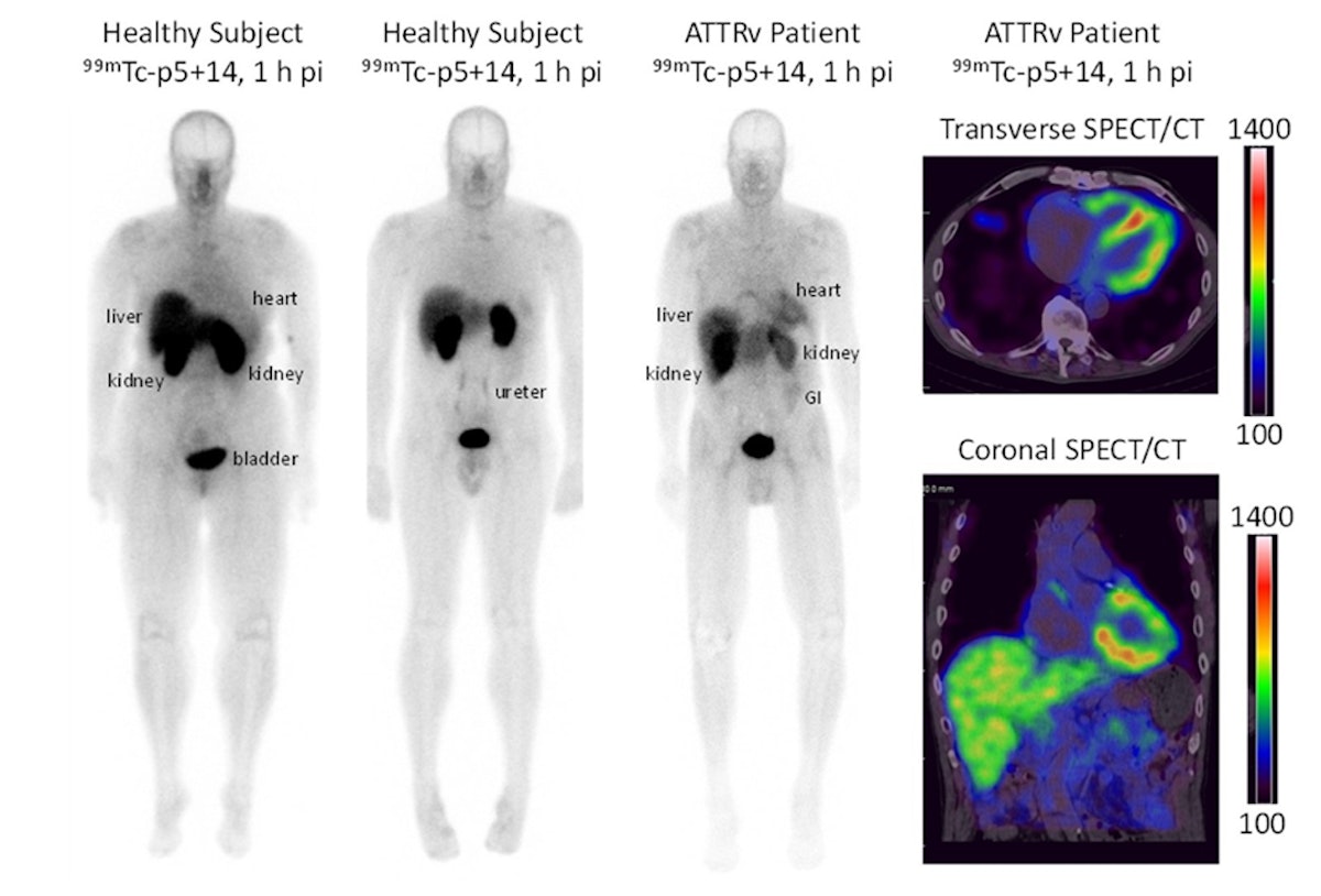 SNMMI: New SPECT/CT radiotracer effectively images cardiac amyloidosis ...