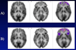 (A) Frontal cortical regions with below-normal metabolism (less than 5th percentile, displayed in color) at baseline, in subject with mild cognitive impairment and untreated hearing loss. (B) Frontal cortical regions with below-normal metabolism two years later. Brighter red colors correspond to more severely diminished metabolism. In contrast, the group of subjects using hearing aids did not undergo significant decline in any frontal cortical region over the same time period. Image courtesy of Natalie Quilala.