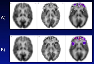 (A) Frontal cortical regions with below-normal metabolism (less than 5th percentile, displayed in color) at baseline, in subject with mild cognitive impairment and untreated hearing loss. (B) Frontal cortical regions with below-normal metabolism two years later. Brighter red colors correspond to more severely diminished metabolism. In contrast, the group of subjects using hearing aids did not undergo significant decline in any frontal cortical region over the same time period. Image courtesy of Natalie Quilala.