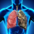 Lung Cancer