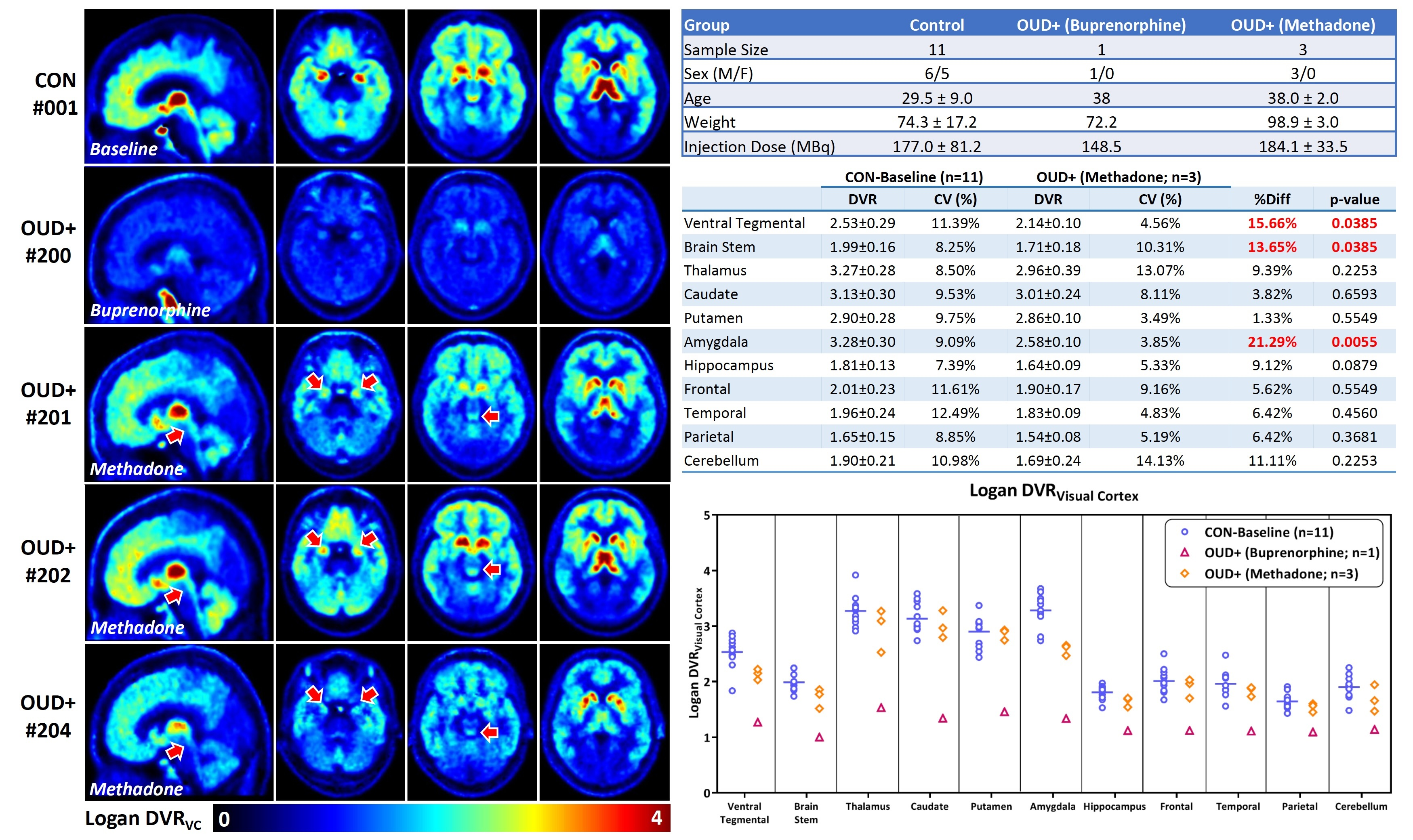 C-11 carfentanil PET brain images in the sagittal plane (left column) and multiple transaxial planes (2nd through 4th columns) are shown on the left side. Red arrows indicate brain stem (1st column), amygdala (2nd column), and ventral tegmentum (3rd column). Experimental group descriptions are shown on the right (top) along with Logan distribution volume ratio (DVR) volumes of interest (VOI) means and coefficient of variances (CV) with percent change compared with the healthy control (HC) mean (%Diff). P-values (Mann-Whitney U test) are also provided. The VOI DVRs are plotted in the bottom right graph.