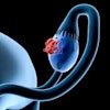 topics for research in ultrasound Ovary