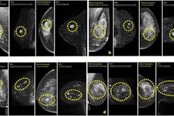(A) Case A was a 13-mm large BI-RADS 4 finding on MRI that corresponded to a 13-mm large invasive cancer as diagnosed in the surgical specimen. (B) Case B was a 9-mm large BI-RADS 4 finding on MRI that corresponded to an 8-mm invasive cancer and 14-mm ductal cancer in situ. (C) Case C was three suspicious lesions within a total area of 60 mm, BI-RADS 5 finding on MRI, that corresponded to a 50-mm multifocal invasive lobular cancer. (D) Case D was two suspicious lesions, the largest 13 mm, BI-RADS 3 on MRI, which corresponded to a 10-mm invasive lobular cancer with 85-mm extent including ductal cancer in situ. Images courtesy of Nature Medicine. Licensed under CC BY 4.0.