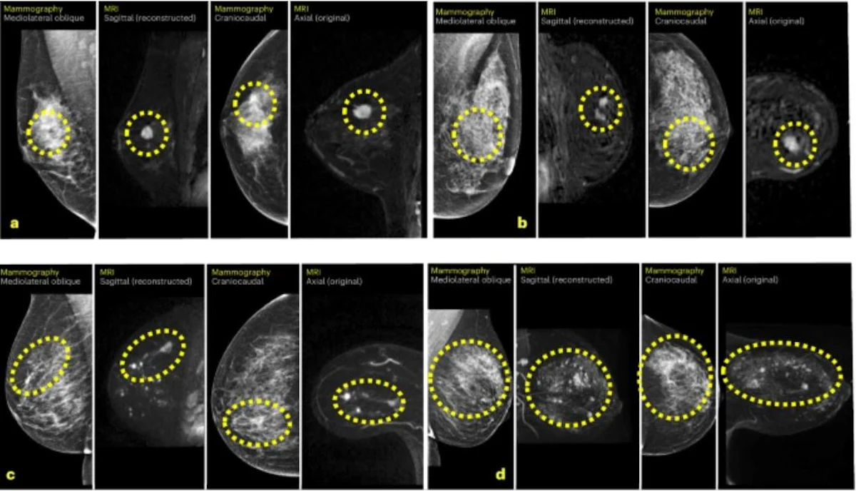 AI increases breast MRI's cancer detection 4-fold | AuntMinnie