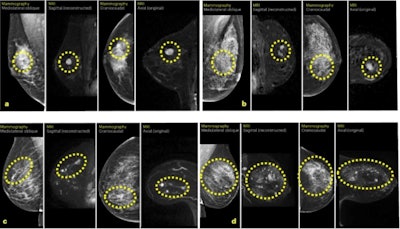 (A) Case A was a 13-mm large BI-RADS 4 finding on MRI that corresponded to a 13-mm large invasive cancer as diagnosed in the surgical specimen. (B) Case B was a 9-mm large BI-RADS 4 finding on MRI that corresponded to an 8-mm invasive cancer and 14-mm ductal cancer in situ. (C) Case C was three suspicious lesions within a total area of 60 mm, BI-RADS 5 finding on MRI, that corresponded to a 50-mm multifocal invasive lobular cancer. (D) Case D was two suspicious lesions, the largest 13 mm, BI-RADS 3 on MRI, which corresponded to a 10-mm invasive lobular cancer with 85-mm extent including ductal cancer in situ. Images courtesy of Nature Medicine. Licensed under CC BY 4.0.