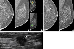 Imaging in a 56-year-old woman with heterogeneously dense breasts (BIRADS C). (A) Left craniocaudal (left) and mediolateral oblique (right) digital mammograms show no abnormality. (B) Left craniocaudal (LCC, top) and left mediolateral oblique (LMLO, bottom) mammograms with retrospectively applied AI (Lunit Insight MMG, version 1.1.7.1; Lunit) show the lesion was given abnormality scores of 97% and 71%, respectively. The color bar indicates pixel-level abnormality scores corresponding to heatmap contour lines. Breast ultrasound performed the same day was considered negative (not shown). (C) Left craniocaudal (left) and mediolateral oblique (right) digital mammograms acquired nine months later show an irregular mass (arrows) in the left breast, which correlates with the heatmap areas scored as 97% and 71% by AI in the earlier screening mammogram (B). The radiopaque round marker denotes the site of the palpable abnormality indicated by the patient. (D) Transverse ultrasound imaging shows an irregular mass (arrow) in the left breast. The patient was treated with breast-conserving surgery, and the mass was proven to be invasive lobular carcinoma. Image courtesy of the RSNA.