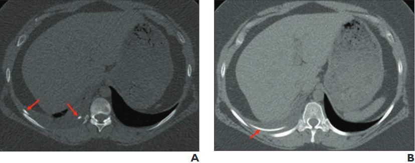 CT images from a 24-year-old woman with history of ventriculopleural shunt placement who presented with chest pain show two small linear hyperattenuating structures (A, arrows), with larger hyperattenuating structure oriented parallel and very close to the rib. The AI algorithm interpreted the finding as a rib fracture. (B) An additional axial image from same exam indicates that the finding relates to the patient&rsquo;s ventriculopleural shunt (arrow), passing alongside the rib. The radiologist made a correct interpretation upon assessment of the entire exam. Image courtesy of the ARRS.