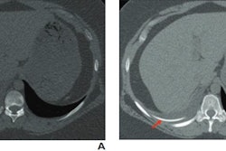 CT images from a 24-year-old woman with history of ventriculopleural shunt placement who presented with chest pain show two small linear hyperattenuating structures (A, arrows), with larger hyperattenuating structure oriented parallel and very close to the rib. The AI algorithm interpreted the finding as a rib fracture. (B) An additional axial image from same exam indicates that the finding relates to the patient’s ventriculopleural shunt (arrow), passing alongside the rib. The radiologist made a correct interpretation upon assessment of the entire exam. Image courtesy of the ARRS.