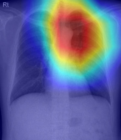 A representative case showing the prognostic value of CXR-Age from a chest x-ray of an individual who received a health check-up. The male individual’s chronological age was 56 years old. CXR-Age estimated biologic age of 68 years old. The Grad-CAM indicates a prominent aortic knob and upper thoracic spines. The patient died after seven years of lung cancer. Image courtesy of Radiology: Artificial Intelligence.