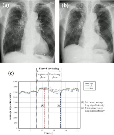 Representative chest radiographs and graphs of lung signal intensity obtained using DDR for the severe COPD group. The subject is a 77-year-old male with VC of 1.68 L and FEV1 of 0.68 L. (a) Radiograph during forced inspiration when the average signal intensity reached its maximum (SImax = 3879.3). (b) Radiograph during forced expiration when the average signal intensity reached its minimum (SImin = 3466.5). (c) Curve graphs depict the temporal change in the signal intensity of entire lung and each individual lung, tracked automatically during respiration, including forced breathing. The signal intensity change (SImax/SImin) was calculated as 1.12. Image courtesy of the European Journal of Radiology Open.