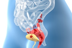 Endometriosis 3 D Illustration 400