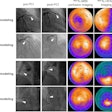 Emergency percutaneous coronary intervention images, Tc-99m MIBI perfusion images and Tc-99m FAPI images of STEMI patients. In STEMI patients, there is a localized yet inhomogeneous uptake of Tc-99m FAPI. Notably, the extent of Tc-99m FAPI uptake significantly surpasses the area of perfusion defects. Despite similarities in coronary artery lesions (culprit vessels identified as the left anterior descending artery in image A and the right coronary artery in image B, white arrows), and comparable myocardial perfusion impairment, patients with larger Tc-99m FAPI uptake areas exhibit ventricular remodeling. Image courtesy of the Journal of Nuclear Cardiology.