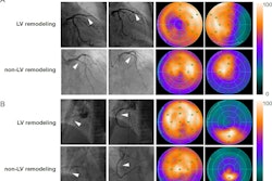 Emergency percutaneous coronary intervention images, Tc-99m MIBI perfusion images and Tc-99m FAPI images of STEMI patients. In STEMI patients, there is a localized yet inhomogeneous uptake of Tc-99m FAPI. Notably, the extent of Tc-99m FAPI uptake significantly surpasses the area of perfusion defects. Despite similarities in coronary artery lesions (culprit vessels identified as the left anterior descending artery in image A and the right coronary artery in image B, white arrows), and comparable myocardial perfusion impairment, patients with larger Tc-99m FAPI uptake areas exhibit ventricular remodeling. Image courtesy of the Journal of Nuclear Cardiology.