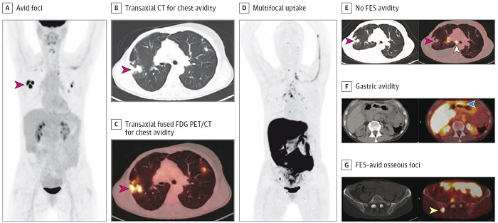The patient was a woman in her 50s with suspected recurrence of invasive lobular breast cancer. A, maximum intensity projection image from FDG-PET/CT demonstrating avid foci in the chest (red arrow). Transaxial CT (B) and transaxial fused FDG-PET/CT image (C) showing that the chest avidity corresponds to FDG-avid lung nodules (red arrows) suspicious for malignancy. The lung nodule was subsequently biopsied but found to represent benign granulomatous inflammation and thus a false positive on FDG-PET/CT. D, maximum intensity projection image from FES-PET/CT demonstrating multifocal uptake suspicious for malignancy. E, transaxial CT and fused FES-PET/CT demonstrating no FES-avidity in the biopsy proven benign granulomatous lung nodules (red arrows), thus true negative on FES-PET/CT. FES-avidity in nodes (white arrow) is suspicious for malignancy. F, transaxial CT and fused FES-PET/CT demonstrates gastric avidity (blue arrow) suspicious for malignancy. G, transaxial CT and fused FES PET/CT demonstrates FES-avid osseous foci (yellow arrow) suspicious for malignancy. This osseous focus was subsequently biopsied and proved to be an osseous metastasis and thus true positive on FES-PET/CT.