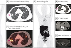 The patient was a woman in her 50s with suspected recurrence of invasive lobular breast cancer. A, maximum intensity projection image from FDG-PET/CT demonstrating avid foci in the chest (red arrow). Transaxial CT (B) and transaxial fused FDG-PET/CT image (C) showing that the chest avidity corresponds to FDG-avid lung nodules (red arrows) suspicious for malignancy. The lung nodule was subsequently biopsied but found to represent benign granulomatous inflammation and thus a false positive on FDG-PET/CT. D, maximum intensity projection image from FES-PET/CT demonstrating multifocal uptake suspicious for malignancy. E, transaxial CT and fused FES-PET/CT demonstrating no FES-avidity in the biopsy proven benign granulomatous lung nodules (red arrows), thus true negative on FES-PET/CT. FES-avidity in nodes (white arrow) is suspicious for malignancy. F, transaxial CT and fused FES-PET/CT demonstrates gastric avidity (blue arrow) suspicious for malignancy. G, transaxial CT and fused FES PET/CT demonstrates FES-avid osseous foci (yellow arrow) suspicious for malignancy. This osseous focus was subsequently biopsied and proved to be an osseous metastasis and thus true positive on FES-PET/CT.