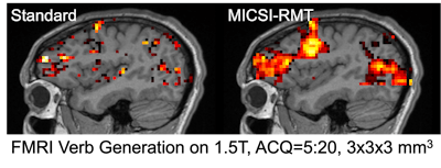 Example of task-based functional MRI performed on 1.5-tesla scanner. Images courtesy of MICSI.