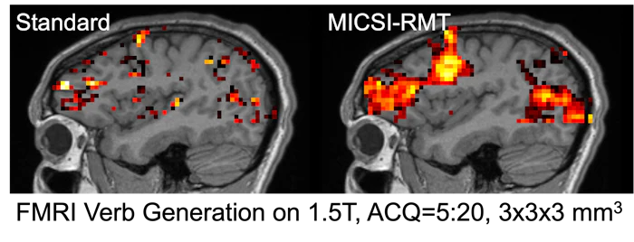 FDA grants MICSI 510(k) for brain MRI image enhancement algorithm