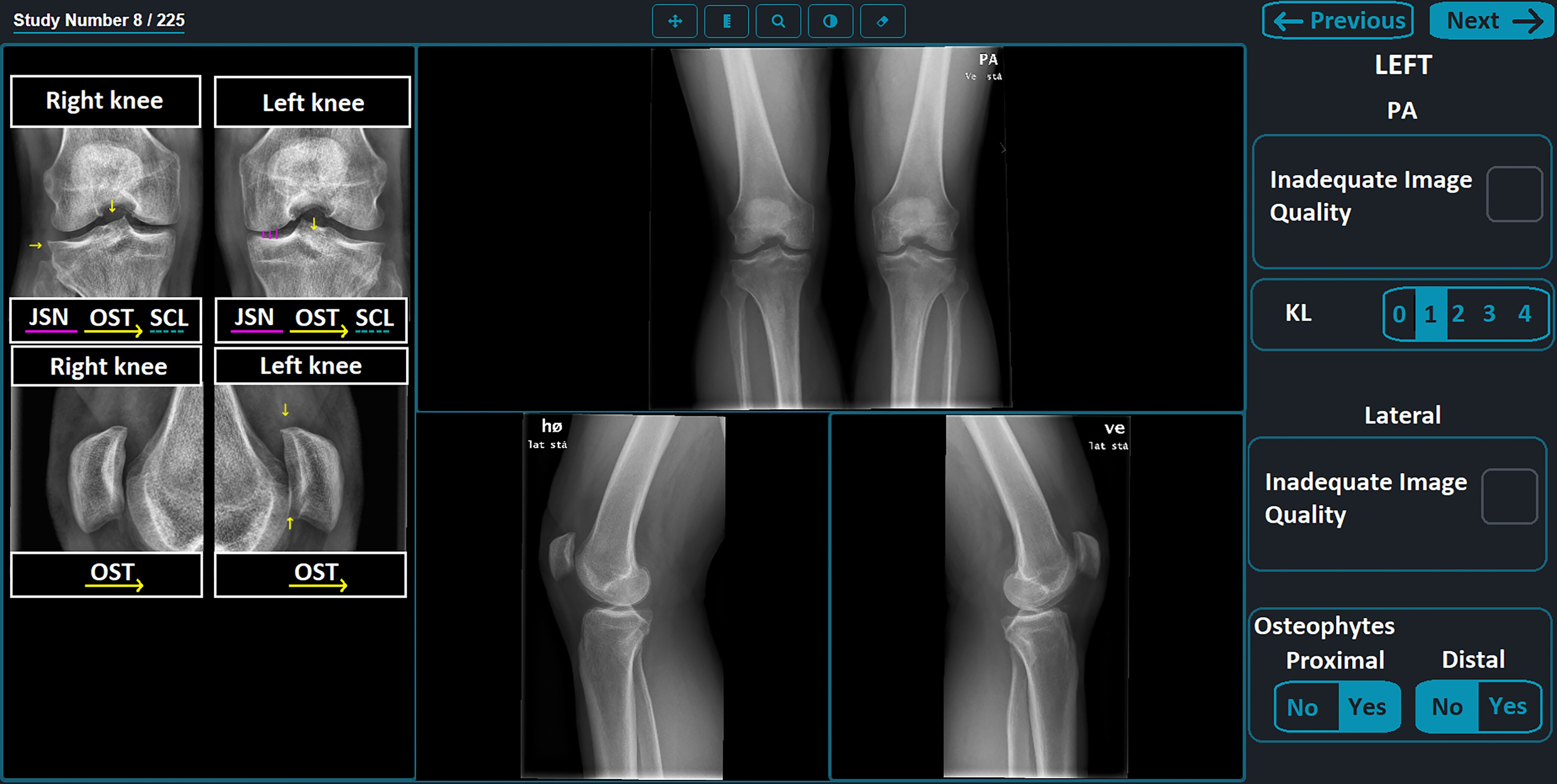 An example of the study platform as seen by a reader receiving assistance from the AI tool. On the left is the overlay generated by the AI tool. On the right is the grading panel. Note that the grading fields are prefilled with the outputs of the AI tool. In this study, the left knee was to be graded. When the right was to be graded, the grading panel was on the left. The size of some user interface elements, primarily text and buttons, have been enhanced to improve legibility. JSN = joint space narrowing, KL = Kellgren-Lawrence, OST = osteophytes, PA = posteroanterior, SCL = subchondral sclerosis. Image and caption courtesy of Radiology.