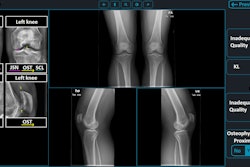 An example of the study platform as seen by a reader receiving assistance from the AI tool. On the left is the overlay generated by the AI tool. On the right is the grading panel. Note that the grading fields are prefilled with the outputs of the AI tool. In this study, the left knee was to be graded. When the right was to be graded, the grading panel was on the left. The size of some user interface elements, primarily text and buttons, have been enhanced to improve legibility. JSN = joint space narrowing, KL = Kellgren-Lawrence, OST = osteophytes, PA = posteroanterior, SCL = subchondral sclerosis. Image and caption courtesy of Radiology.