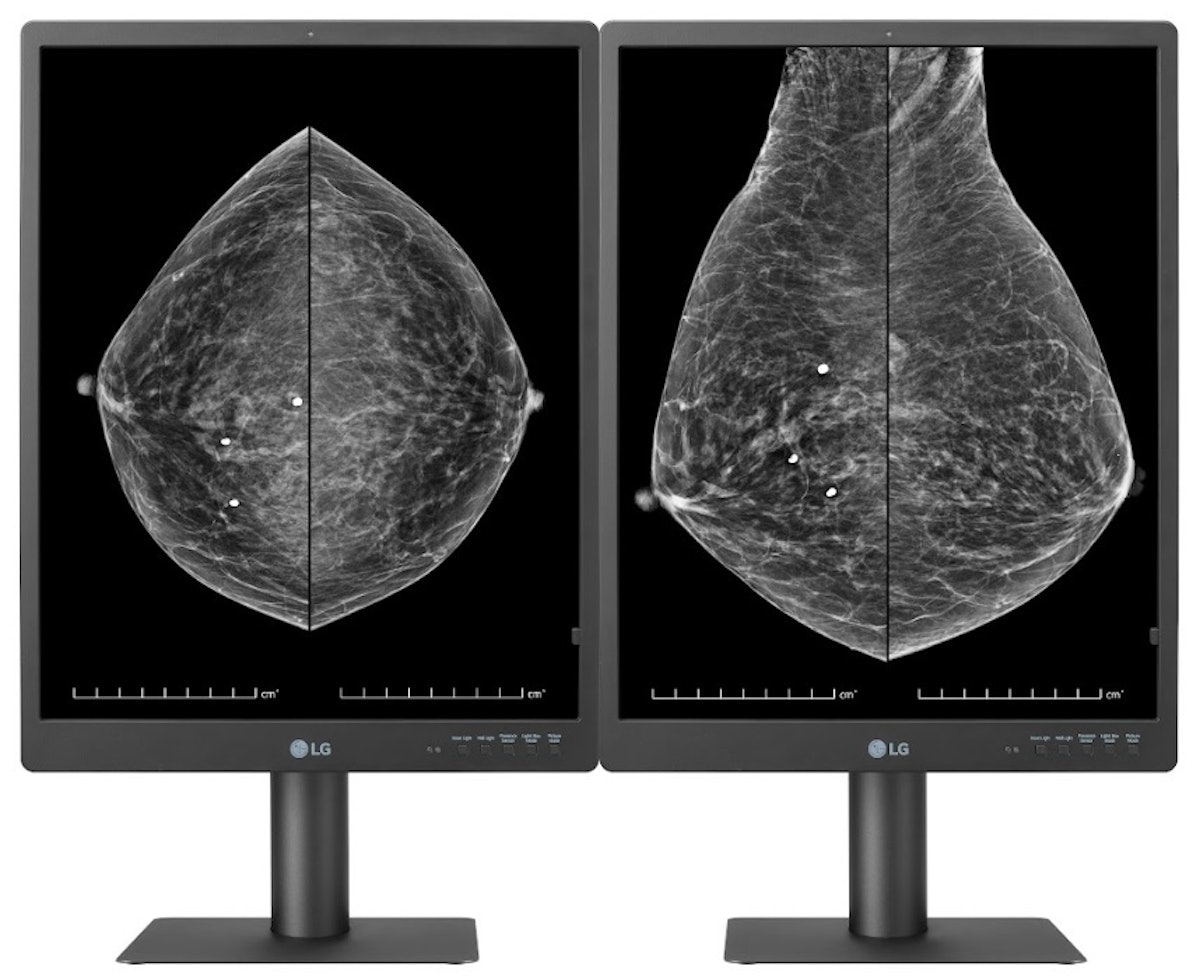 Diagnostic Breast Imaging 第2版 Diagnostic Breast Imaging: Mammography, Sonography, MRI and
