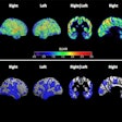 Example of the flortaucipir tau-PET signal and distribution of low grey matter volume in a single former athlete. Spatial maps of the flortaucipir tau-PET standardized update value (SUVR) (top) and the reduced grey matter volumes showed in blue and defined as voxels with a w-score of >1.5 below the mean (bottom) in a single former athlete. Image courtesy of the Journal of Neurology.