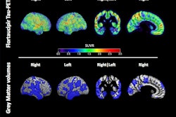 Example of the flortaucipir tau-PET signal and distribution of low grey matter volume in a single former athlete. Spatial maps of the flortaucipir tau-PET standardized update value (SUVR) (top) and the reduced grey matter volumes showed in blue and defined as voxels with a w-score of >1.5 below the mean (bottom) in a single former athlete. Image courtesy of the Journal of Neurology.
