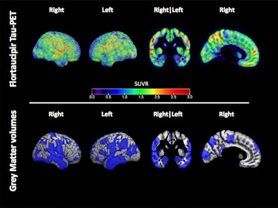 Example of the flortaucipir tau-PET signal and distribution of low grey matter volume in a single former athlete. Spatial maps of the flortaucipir tau-PET standardized update value (SUVR) (top) and the reduced grey matter volumes showed in blue and defined as voxels with a w-score of >1.5 below the mean (bottom) in a single former athlete. Image courtesy of the Journal of Neurology.