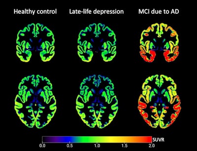 Coronal and axial slice of the average cortical F-18 MK-6240 SUVR [standard uptake value ratio] image for each study population. SUVR images were corrected for partial volume effects and masked with the gray matter mask used for volume of interest delineation. Overall tau accumulation is comparable between the late-life depression (LLD, middle column) and non-depressed cognitively unimpaired comparison (HC, left column) groups, while abnormal tau accumulation, which is most pronounced in the mesial temporal lobe, can be seen in the mild cognitive impairment due to Alzheimer's disease group (right column). Image and caption courtesy of the American Journal of Geriatric Psychiatry.