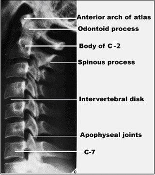 Lateral view of cervical spine. The film in this projection clearly shows the vertebral bodies, apophyseal joints, spinous processes, and intervertebral disc spaces. It is mandatory to demonstrate the C-7 vertebrae. Image courtesy of Dr. Naveed Ahmad.