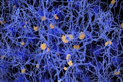 Amyloid Plaque Alzheimer